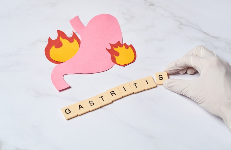 Una rappresentazione della gastrite