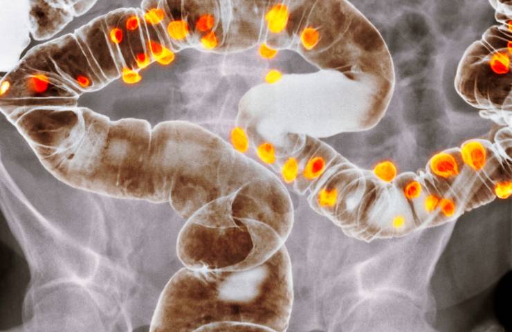 Uno schema illustrativo di una situazione di diverticolite