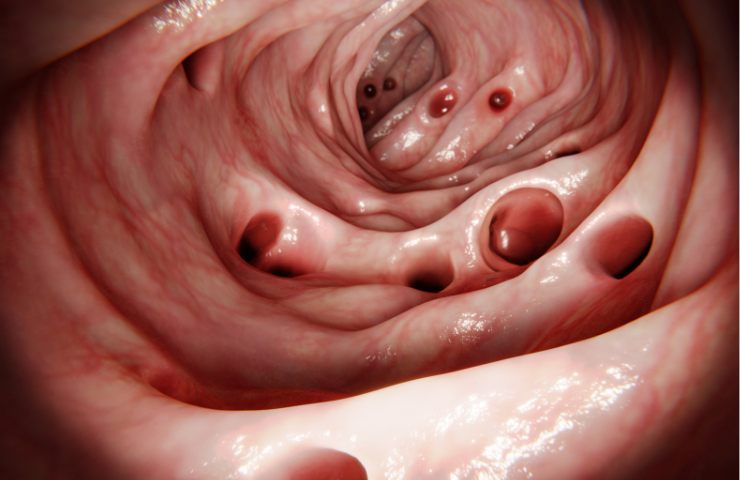 Una rappresentazione della diverticolite