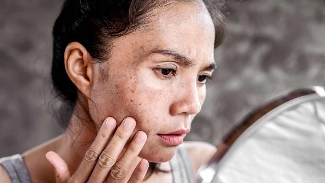 Macchie della pelle buttalapasta.it